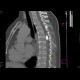 Meningioma of the spinal canal: CT - Computed tomography